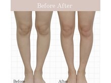 アロエ(Aloe)の雰囲気（足のむくみビフォーアフター）