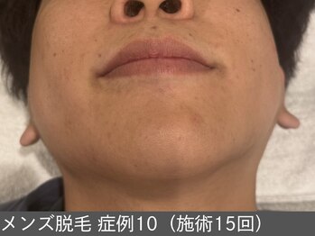 オアシスラグーン(OASIS LAGOON)/メンズ脱毛(症例10 施術15回)