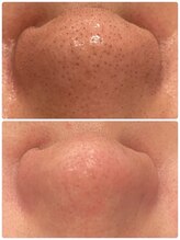 アルモ(ALMO)/美容液毛穴洗浄フェイシャル