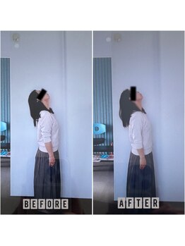 イトウ カイロプラクティックパートナー(ITOU)/Before&After