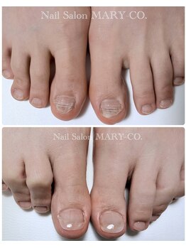 マリーシーオー(MARY-CO.)/フット深爪矯正