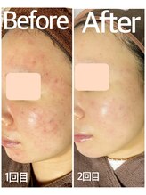 おうちサロン ミキ/BeforeAfterピーリング