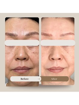 エルブラン(Herb ame)/肌質改善/しみ/しわ/たるみ改善