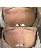 ミジョカフェイシャル(mijoka facial)/おでこも綺麗に♪