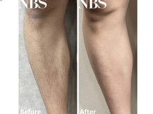 ミュースタイル(mieux-style)/THR脱毛