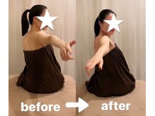 肩こり　首こり　筋膜リリースカッピング　カッピング　デコルテ