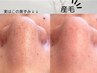 【韓国式3D毛穴洗浄】＋鼻まわり産毛脱毛　毛穴診断付き￥31600→￥15800