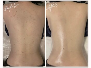 ミューベル(MYubelle)/シミくすみ改善 水光ピーリング