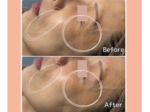 ベルミーランド 浜松天王/フェイシャルBefore→After