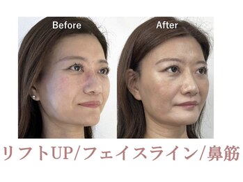 ラプリ 盛岡店(Raplit)/隆鼻＋輪郭矯正40分10回