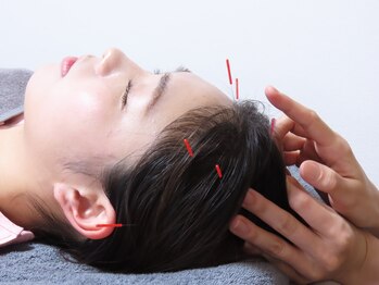 鍼灸院アム(Amu)/頭の鍼