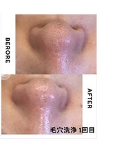マヴィ 藤井寺店(MavY.)/毛穴洗浄1回目