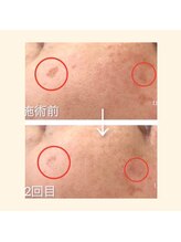 毛穴専科/ほぼ痛み０！シミケア沖縄/那覇