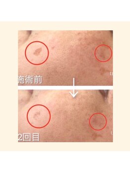 毛穴専科/ほぼ痛み0!シミケア沖縄/那覇