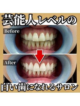 トワ 大宮(TOWA)/~セルフホワイトニング・症例~