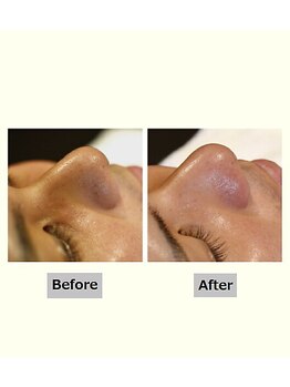 ペールノエル 富士宮店(PERENOEL)/ハイドラフェイシャル(20代男性)