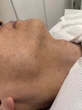 ミータイムコト(METIMEKOTO)/【メンズ脱毛】ひげ脱毛