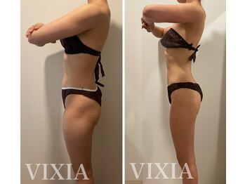 ヴィクシア(VIXIA)/痩身90分