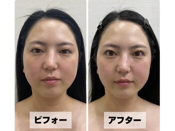 ほねつぎ 平成けやき通り鍼灸接骨院/πテラピー ビフォー/アフター1