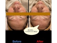 プレミアムキュア/ヒト幹細胞導入＋ウルトラパルス