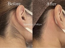 ワクシー 麻布十番店(WAXYYY.)/うなじワックス