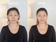 アリス(Alice)/フェイシャル小顔矯正 45分