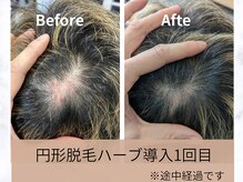 アリー(Alii)の雰囲気（グリーンピールヘアブースト【びまん性/抜け毛/頭皮改善/】）