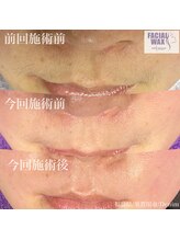 デニム(Denim)/永久な脱毛ではありませんが、