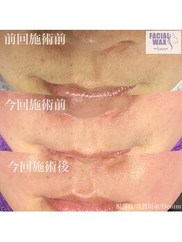 デニム(Denim)/永久な脱毛ではありませんが、