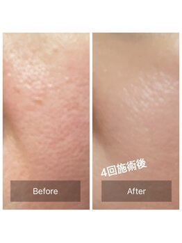 エステシオン(ESTESiON)/ハーブピーリングBeforeAfter