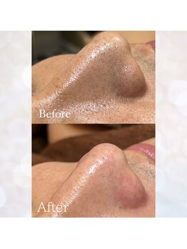 ビスイ 恵比寿(Bisui)/毛穴エクストラクション/毛穴