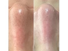 エステティックサロン Sの雰囲気（オプションで毛穴ケア（5500円）をプラス。１回でこの効果です！）