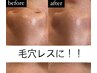 【いちご鼻解消ケア】Tゾーンの黒ずみを毛穴洗浄でツルツルに！¥4,500