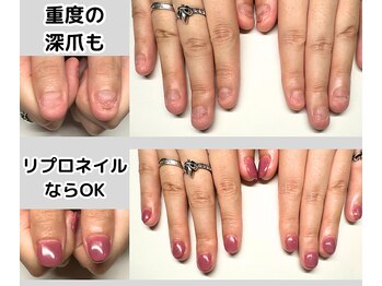 即日見た目改善！深爪ネイル♪