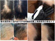 国内初！100%幹細胞培養上清液と最新マシンノアグロウで育毛促進