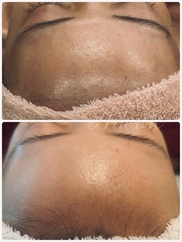 エルール トータルビューティ(Aileure total beauty)/最先端のVOSハーブピーリング