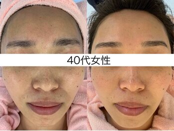 シミケア専門店 SAKURA 平塚店/30代前半　8回目