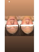 ルルアス(LuLu AS)/シリカニードル４回目