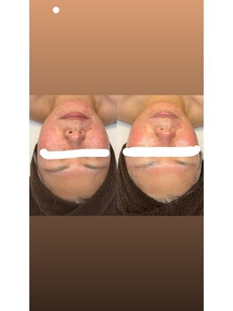 ルルアス(LuLu AS)/シリカニードル４回目