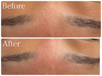 ブリエ(Briller)/毛穴の開き改善!