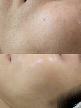 スターリー ラッシュ(Starry Lash)/全顔ワックス脱毛で毛穴レス★