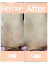 おうちサロン ミキ/BeforeAfterピーリング