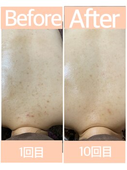 おうちサロン ミキ/BeforeAfterピーリング