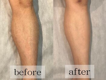 グランビューティ(Glanz Beauty)/20代男性