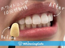 ホワイトニングカフェ 松本店(WhiteningCafe)/ ◎歯のホワイトニング施術写真