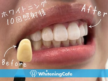 ホワイトニングカフェ 松本店(WhiteningCafe)/ ◎歯のホワイトニング施術写真