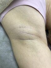 ナノハナ/鹿沼市の全身脱毛のナノハナ