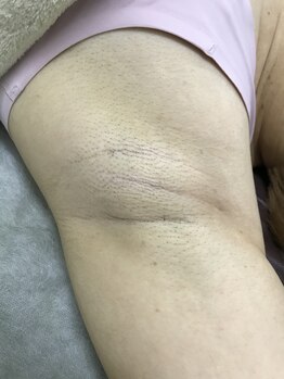 ナノハナ/鹿沼市の全身脱毛のナノハナ