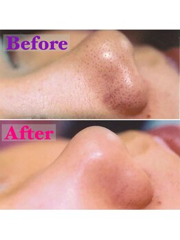 ルイマリー(Rui Mary)/毛穴大掃除コース　