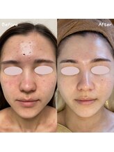 ミーラヤ(MILAYA)/梅田毛穴/梅田リアボーテ